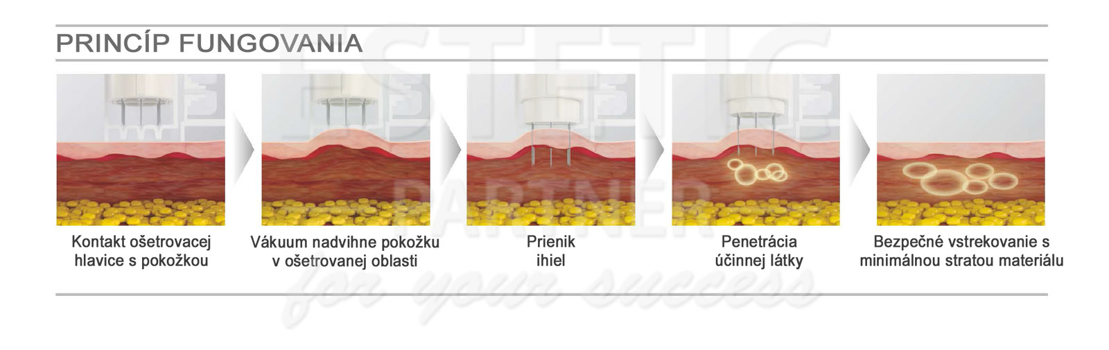 EunSung Vital Injector 3 - PRINCÍP FUNGOVANIA